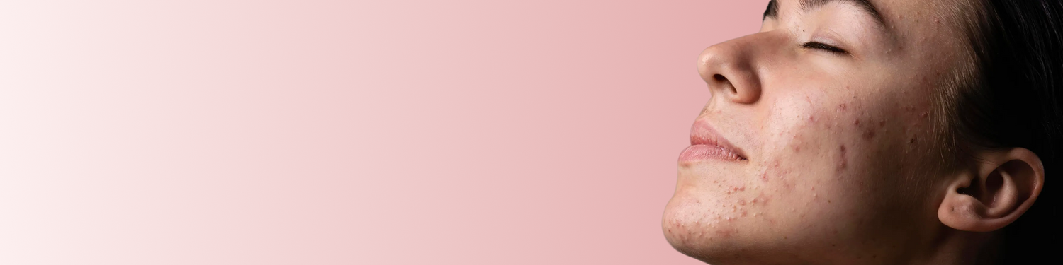 Hyperpigmentation
